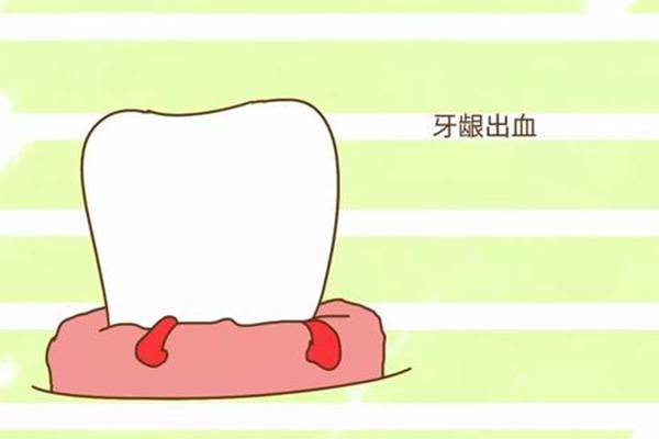 一漱口牙龈就出血是什么原因呢吃什么药
