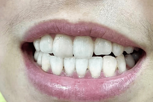 12岁孩子牙齿发黑烂掉怎么办啊(12岁孩子牙齿发黑烂掉怎么办啊图片)