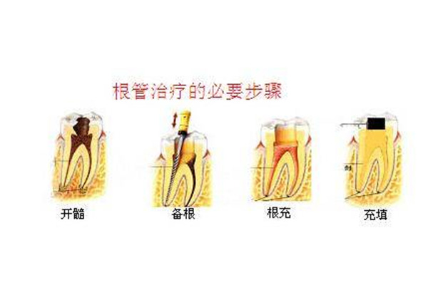 9岁能做根管治疗吗(9岁能做根管治疗吗多少钱)
