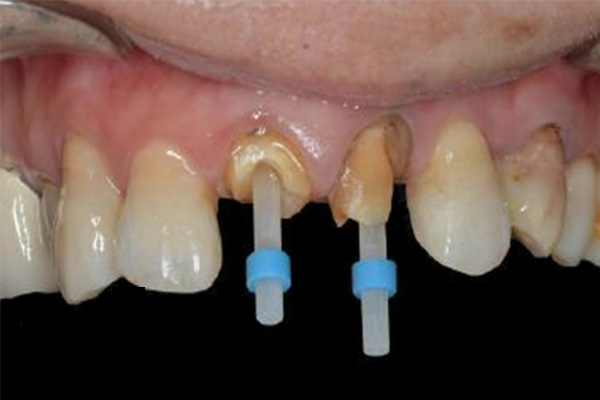 800一颗全瓷牙医生赚多少(一颗全瓷牙的利润)