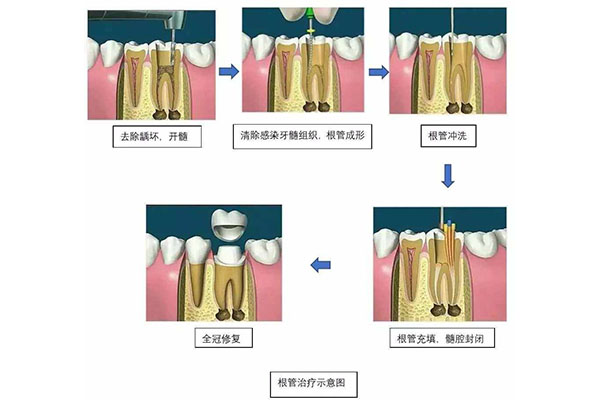 一次性根管治疗和普通根管治疗的区