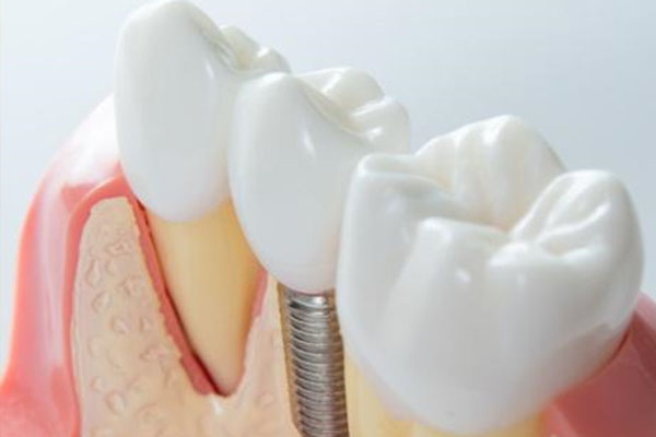 60岁种牙的危害有哪些症状表现(60岁种牙的危害有哪些症状表现呢)