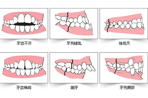 儿童牙齿不齐怎么办吃什么药好使(儿