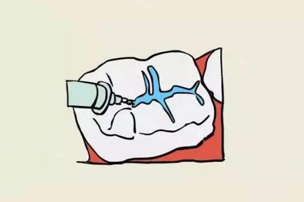 小孩牙齿涂氟吗多少钱(小孩牙齿涂氟