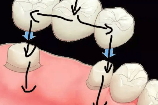 一个烤瓷牙大概多少钱人民币一颗(一个烤瓷牙价格是多少)