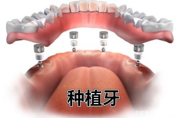 40岁还能不能种牙齿(40岁还能不能种牙齿呀)