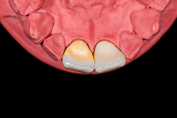 对于活动假牙,应该怎么放置和使用(对于活动假牙应该怎样放置和使用)
