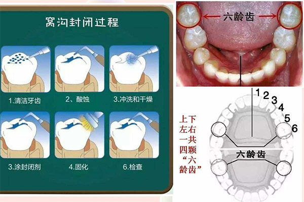2岁宝宝做窝沟封闭有必要吗(2岁做窝沟封闭合适吗)
