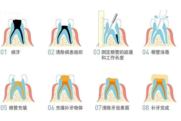 一颗牙齿根管治疗费用多少(一颗牙齿