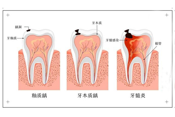 中医治疗牙髓炎有效吗(中医治疗牙髓