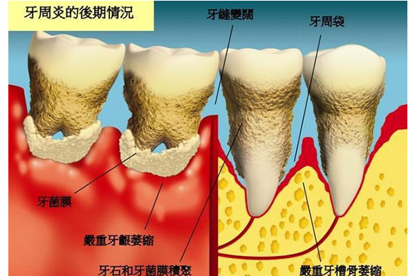 30多岁牙龈萎缩牙齿松动厉害怎么办