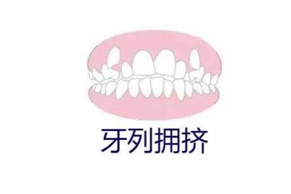 孩子牙列拥挤多大治疗(孩子牙列拥挤多大治疗合适)