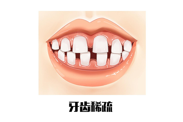 牙齿稀疏牙缝大是用牙贴面还是矫正