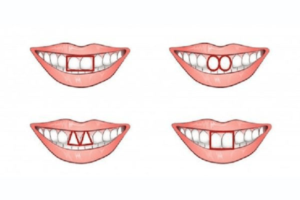 80岁老人适合种牙还是镶牙辽阳映雪口腔种牙多少钱(八十岁老人种牙)