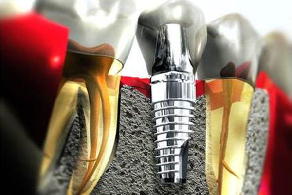 2020年种牙可以走医保吗多少钱(2020年种牙可以走医保吗多少钱一颗)