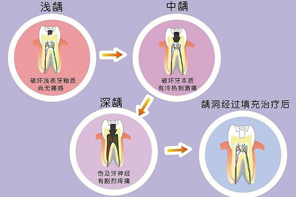 25岁牙齿全是蛀牙正常吗怎么治疗(25岁牙齿全是蛀牙正常吗怎么