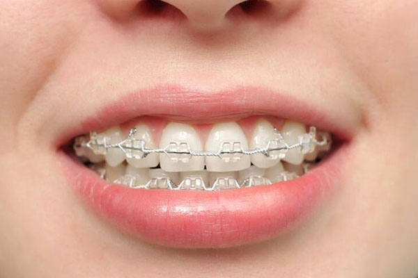 下门牙拥挤是什么原因造成的呢吃什么药(下门牙拥挤是什么原因造成的呢吃什