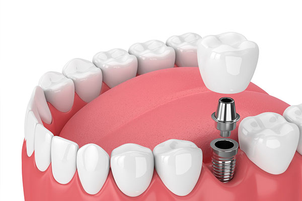 2020年种牙收费价目表(2020年种牙收费价目表及图片)