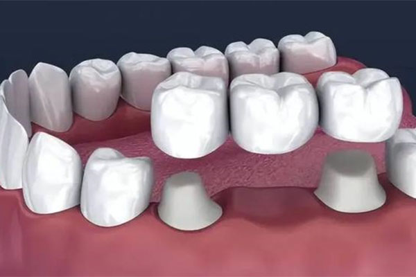 一千块钱一颗的全瓷牙用的几年了(一千块钱一颗的全瓷牙用的几年了能换吗)