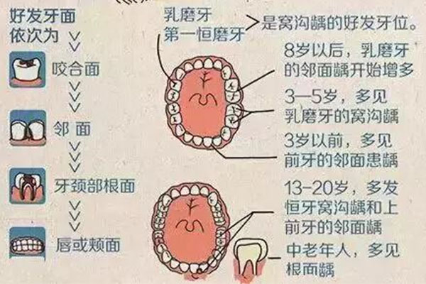 后槽牙后边长了一个小牙齿(后槽牙后
