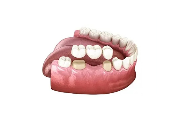 50岁镶牙还是种牙好些呢(50岁镶牙还是种牙好些呢图片)