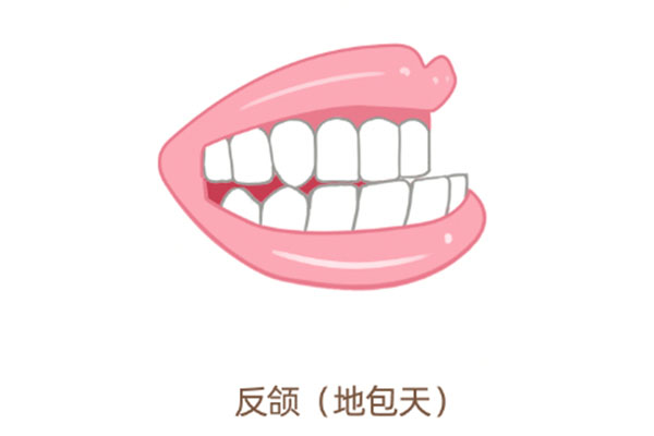 2岁宝宝地包天能自愈吗(儿童地包天矫