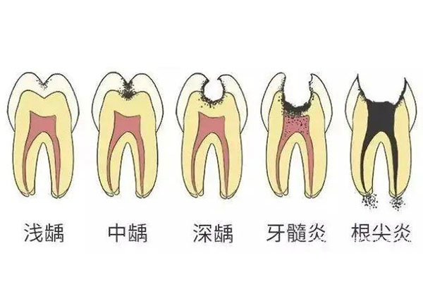 中医治疗牙周炎神器(中医治疗牙周炎