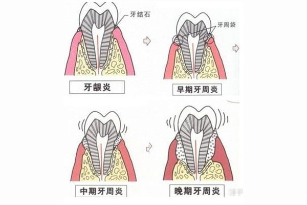 中医治牙周炎的药方是什么呢(中医治牙周炎的药方是什么呢)