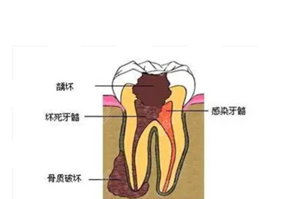 10岁儿童蛀牙已经烂空了怎么办呀(10岁儿童蛀牙已经烂空了怎么