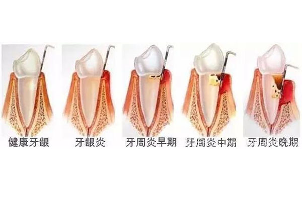 严重牙周炎牙齿松动先拔牙,还是先刮