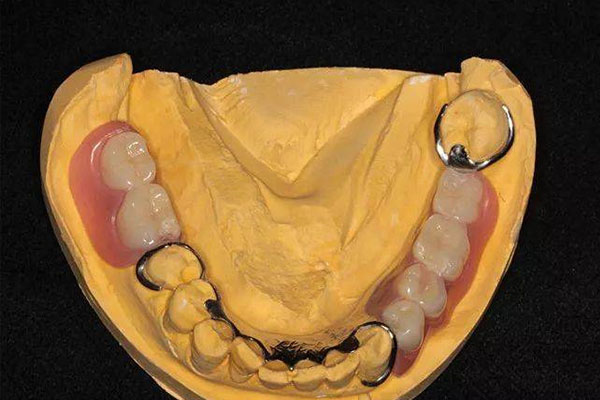 上海义齿加工厂怎么样招聘普工(上海义齿加工厂怎么样招聘普工)