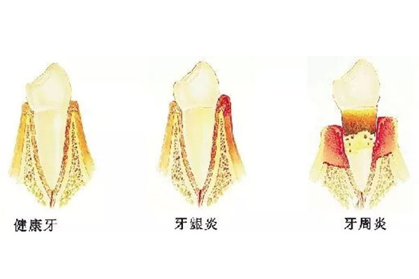 严重的牙周炎能治愈吗多少钱啊(严重