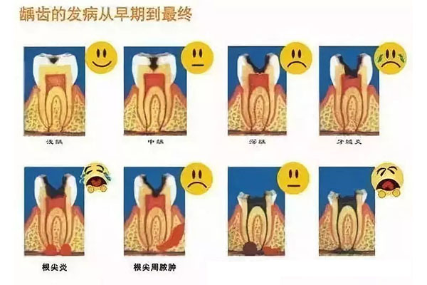 25岁蛀牙了怎么办呢(25岁蛀牙了怎么办呢)