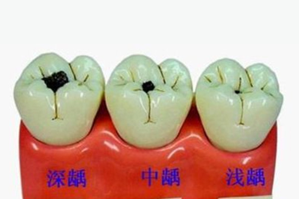 20多岁好多蛀牙(二十多岁很多蛀牙)