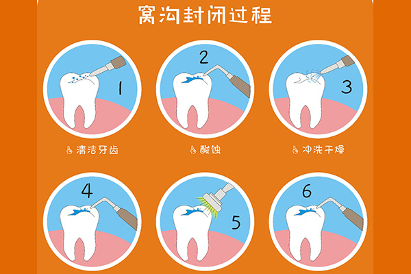 小孩儿牙齿涂氟多少钱一次(小孩儿牙齿涂氟多少钱一次图片)