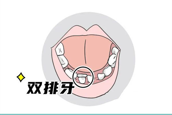 上排的牙齿后面长了个小牙齿正常吗