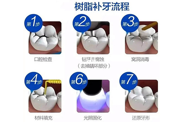 3m树脂补牙p60价格(3mp60树脂补牙材料的