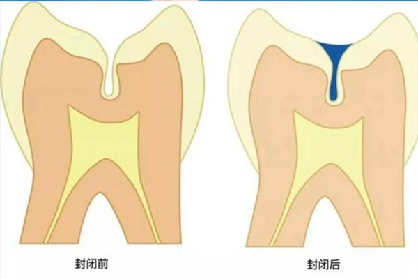 9岁了还能做窝沟封闭吗(九岁孩子可以做窝沟封闭吗)