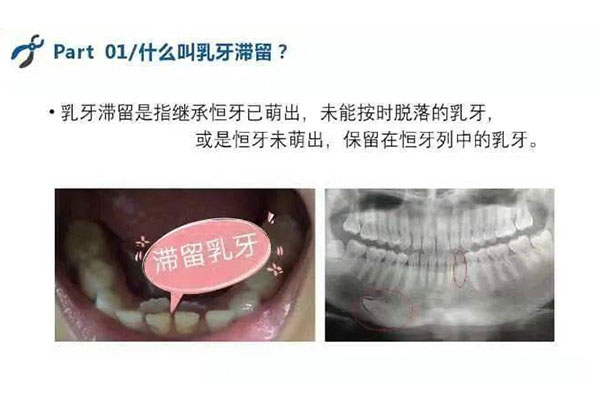 乳牙滞留又长新牙怎么办啊吃什么药