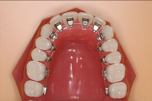 如何判断牙齿是否拥挤了(如何判断牙齿是否拥挤了图片)