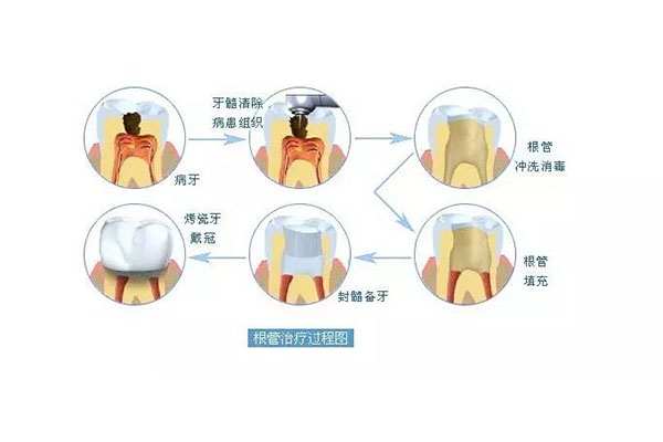 4岁做根管治疗全部费用(4岁做根管治