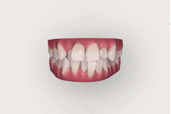 义获嘉染色树脂(义获嘉染色树脂使用流程)