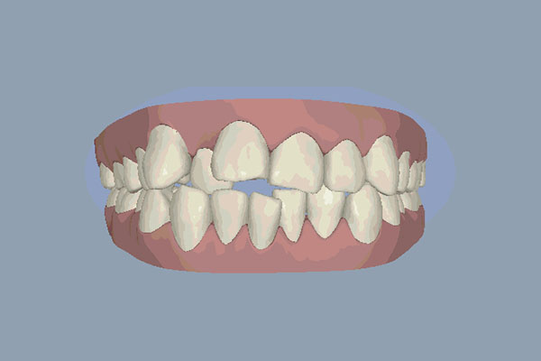 牙齿不齐修(牙齿不齐修图能修吗)实战性强