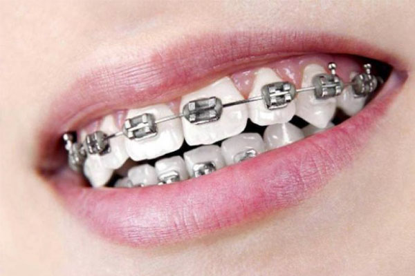 牙列拥挤的常用矫正方法(牙列拥挤的常用矫正方法有哪些)