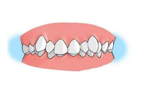 牙不齐可以做牙贴面吗多少钱一个(牙不齐能做牙贴面吗)一文认识深入