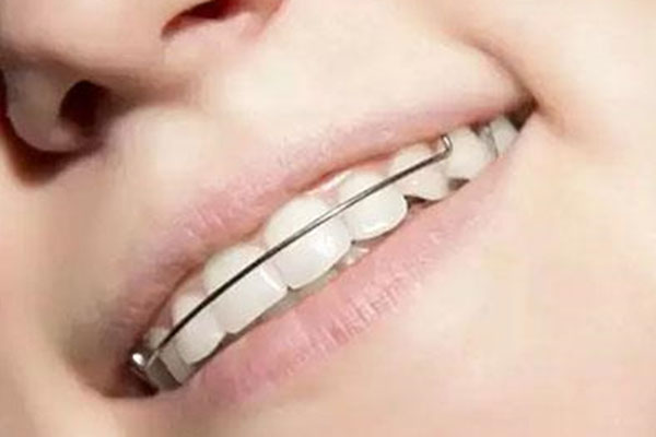 牙列不齐牙齿拥挤(牙列不齐牙齿拥挤怎么矫正)