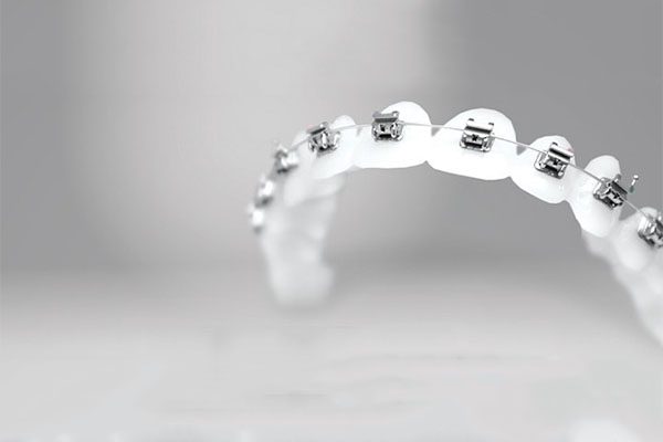 牙弓拥挤程度分为(牙弓拥挤程度分为几种)