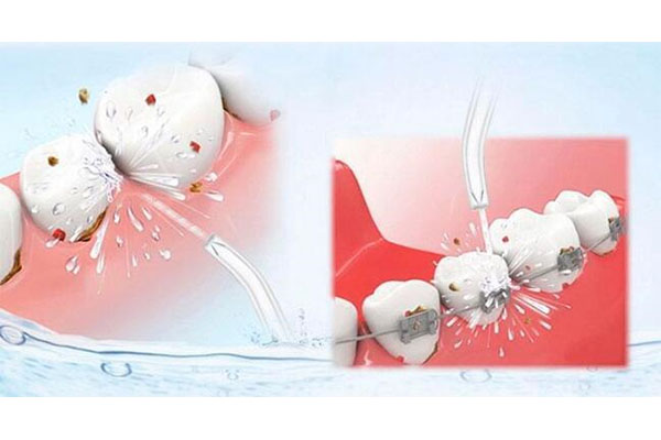 洁牙一次大概多少钱一颗牙(洁牙一次大概多少钱一颗牙呢)