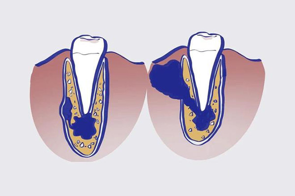 5岁矫正地包天,换牙期会反复吗(五岁地包天矫正后会反弹吗)