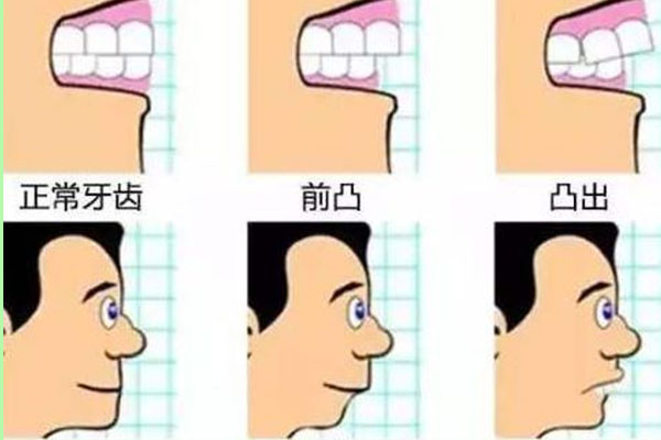 8岁女孩地包天能治好不(8岁女孩地包天要怎么矫正)